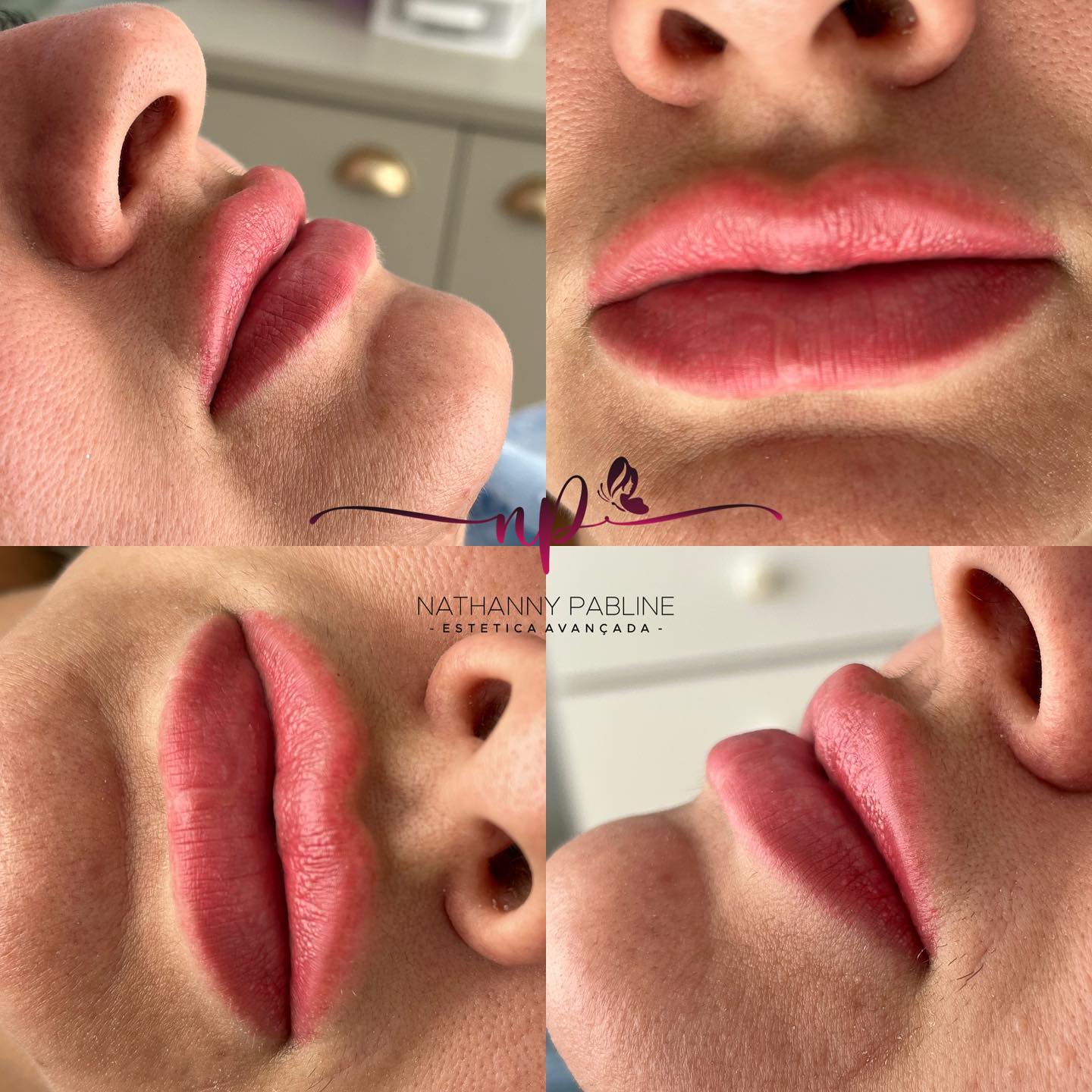 Dra.-Nathanny-Pabline-Preenchimento-Labial-1
