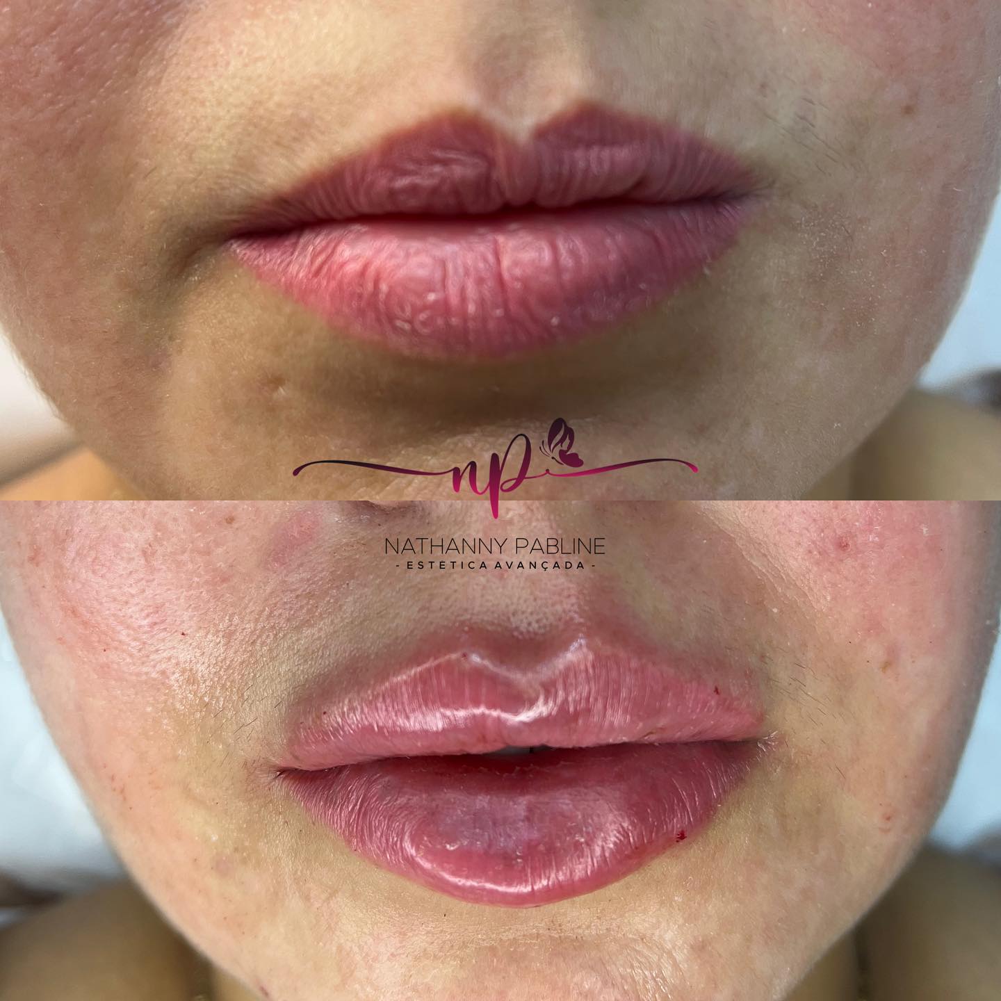 Dra.-Nathanny-Pabline-Preenchimento-Labial-2.1