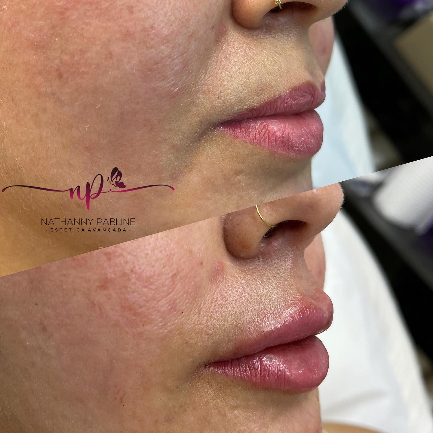 Dra.-Nathanny-Pabline-Preenchimento-Labial-2.2