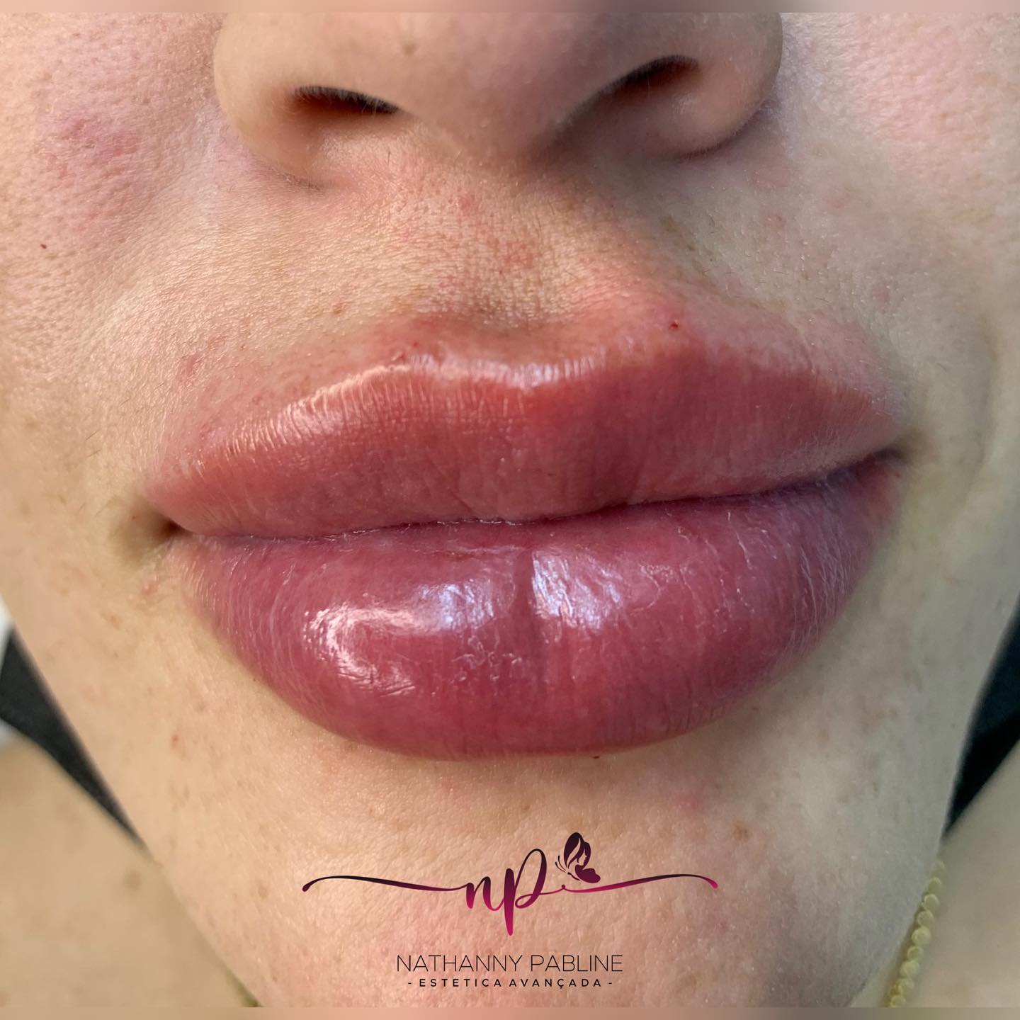 Dra.-Nathanny-Pabline-Preenchimento-Labial-3.1