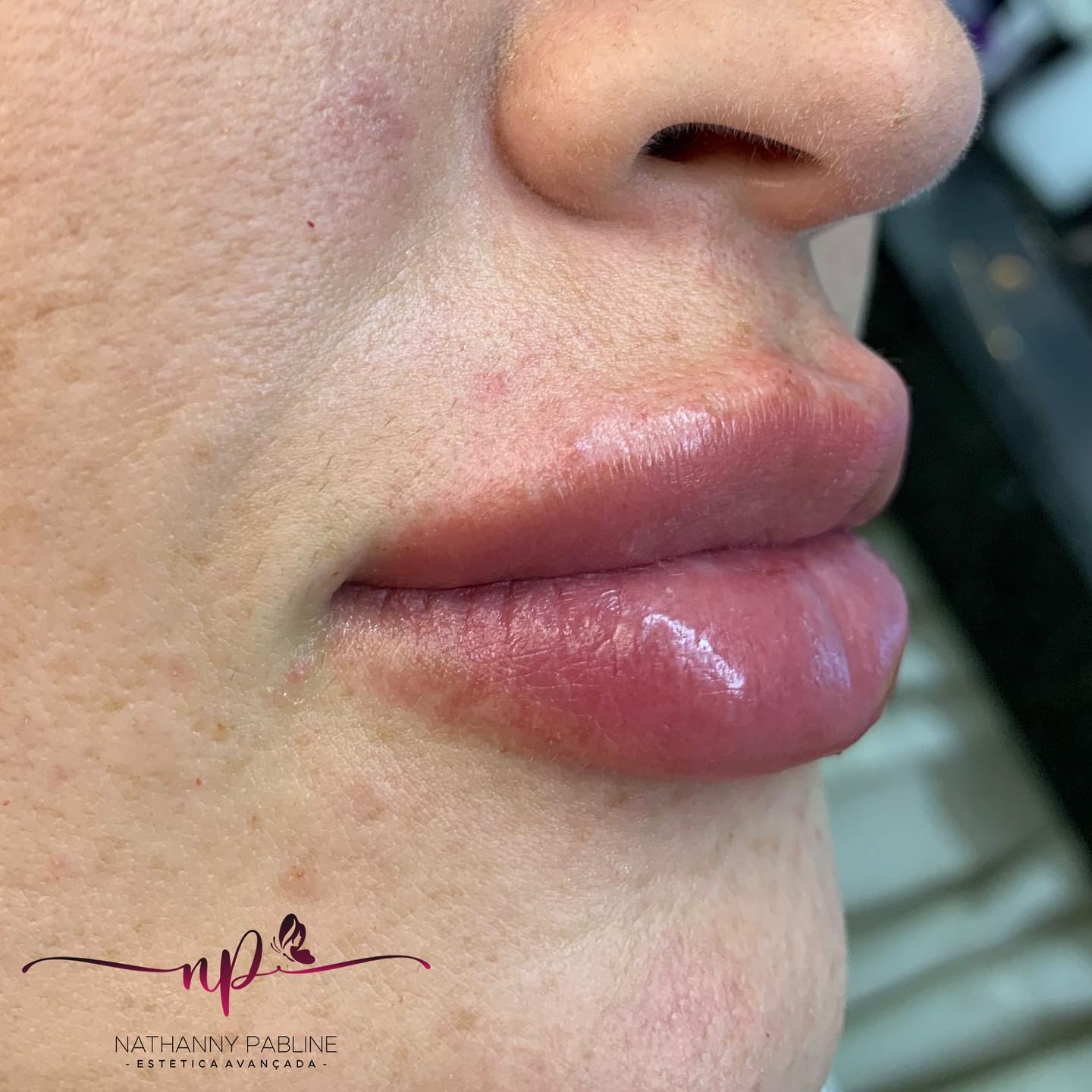 Dra.-Nathanny-Pabline-Preenchimento-Labial-3.2