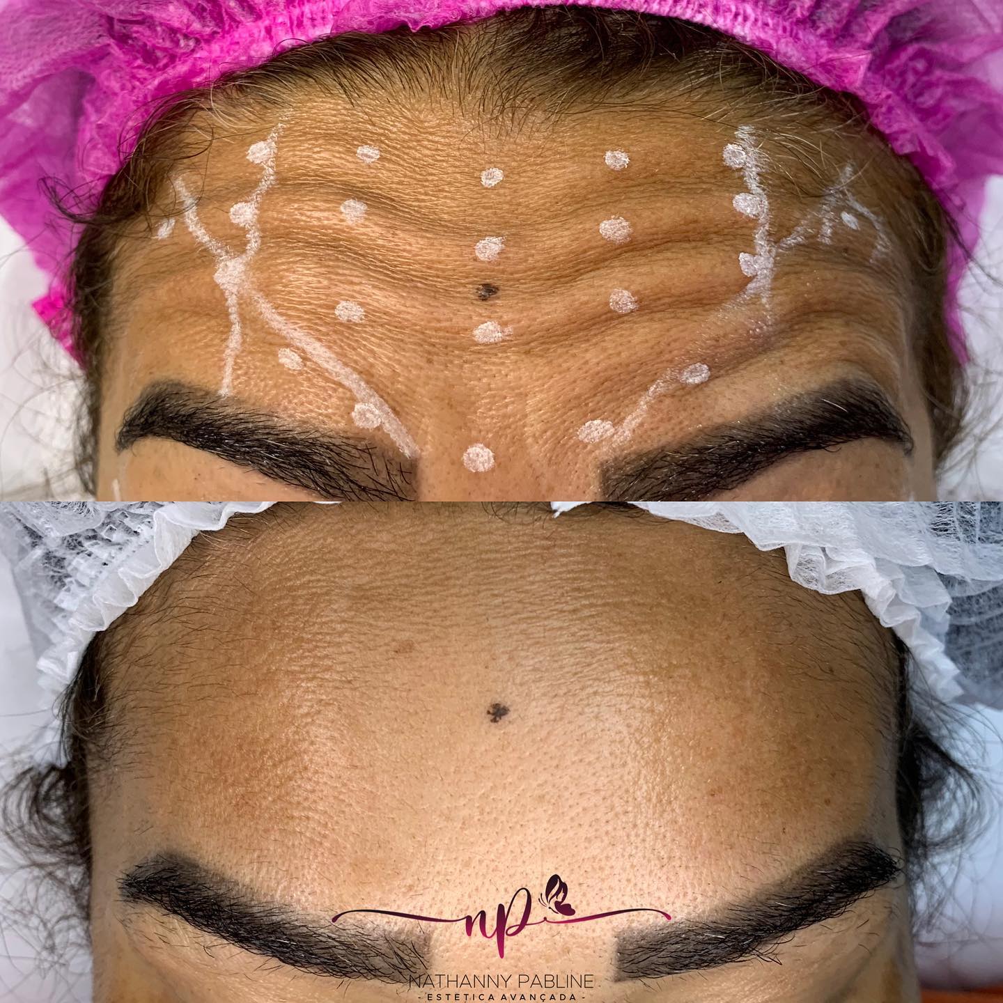 Dra.-Nathanny-Pabline-Toxina-Botulinica-1.1